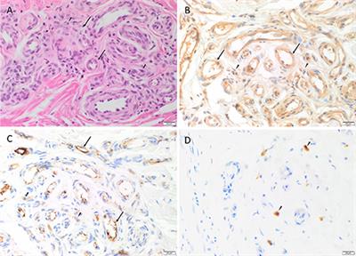 Expression of Cathepsins B, D, and G in Extracranial Arterio-Venous Malformation